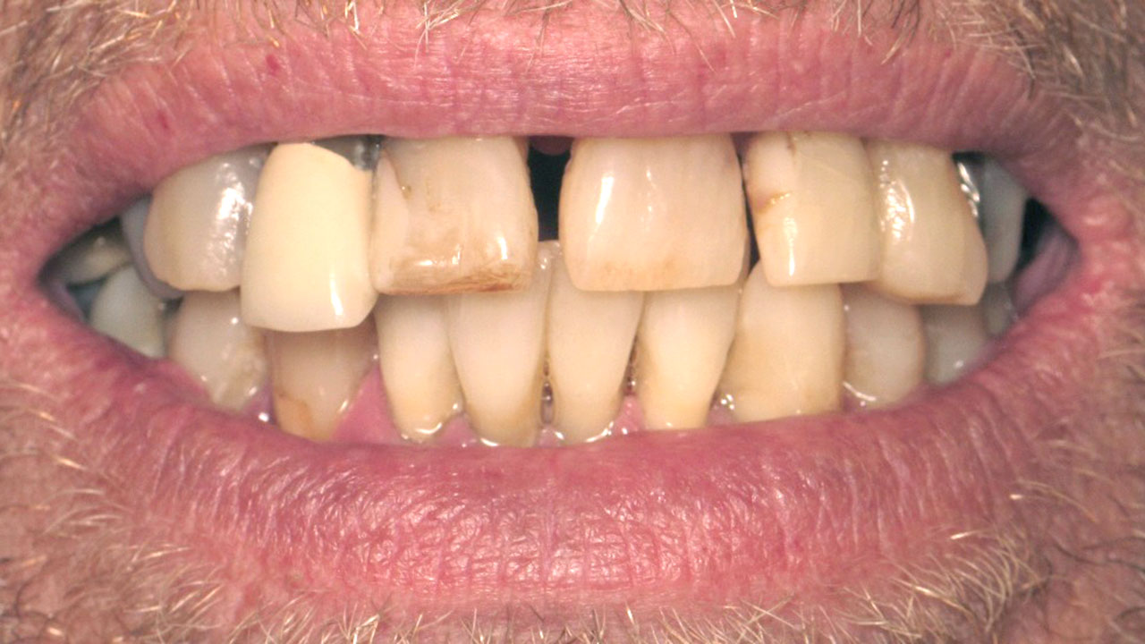 Complete Upper Denture Lower Partial Before Close Smile Grandville Mi