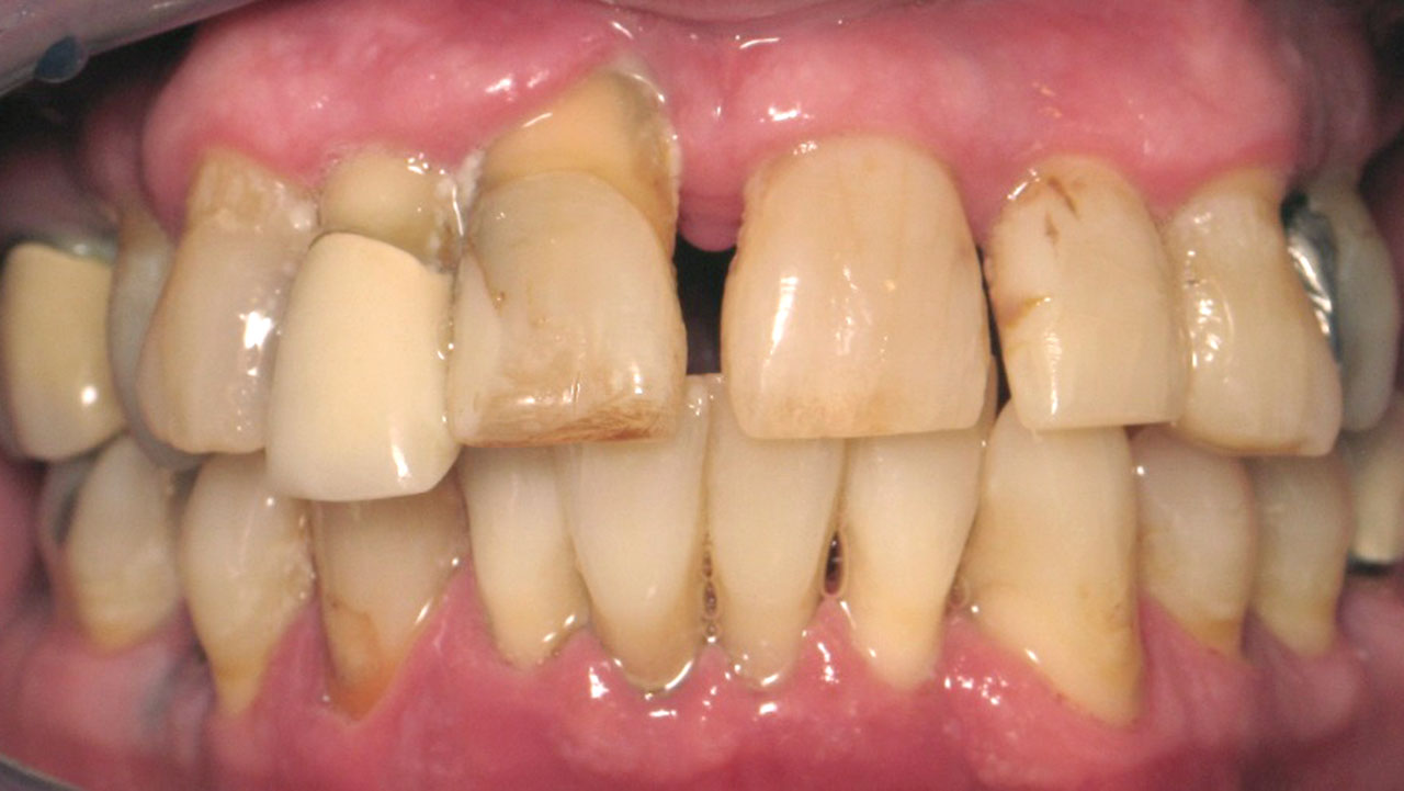 Complete Upper Denture Lower Partial Before Retracted Grandville Mi