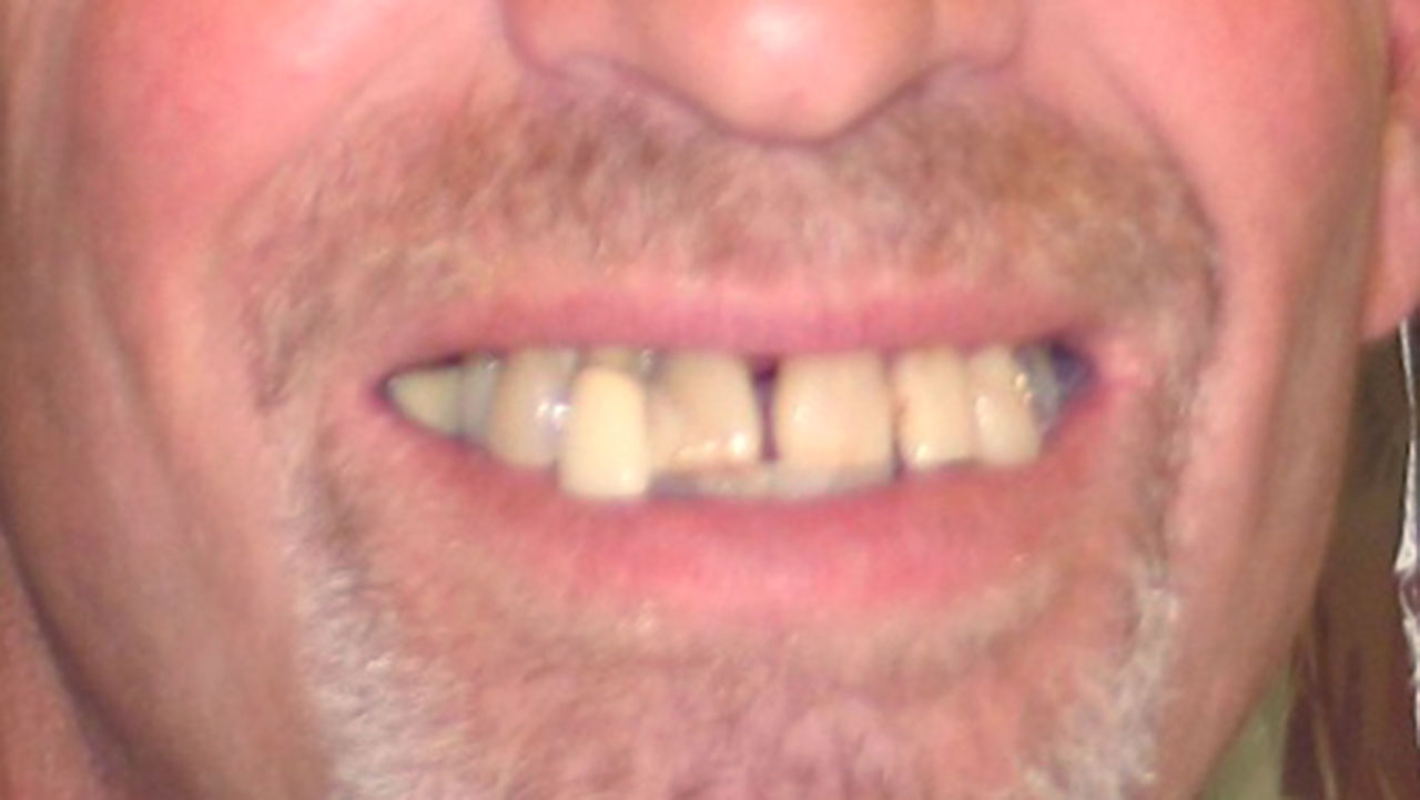 Complete Upper Denture Lower Partial Before Smile Grandville Mi
