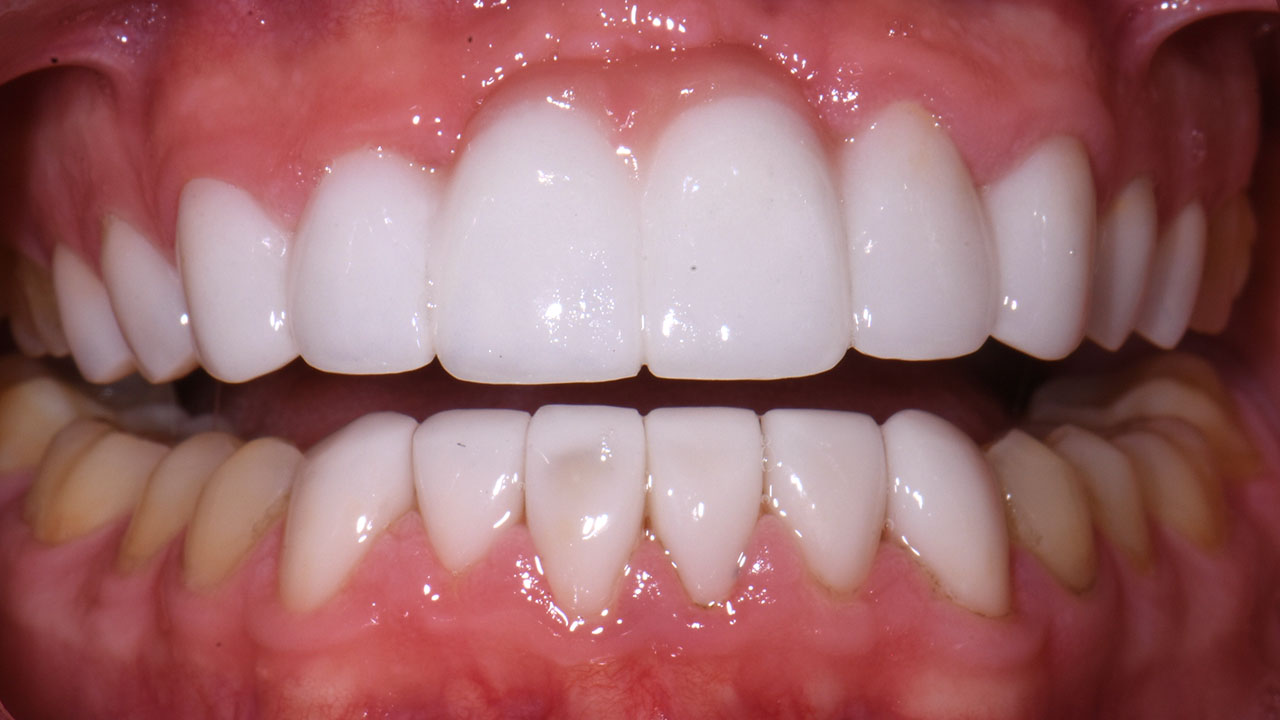Cosmetic Smile Rehabilitation Bridge Retracted After Grandville Mi