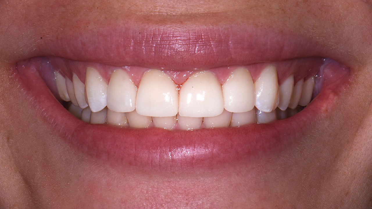 Dental Crown After Dentist Grandville Mi