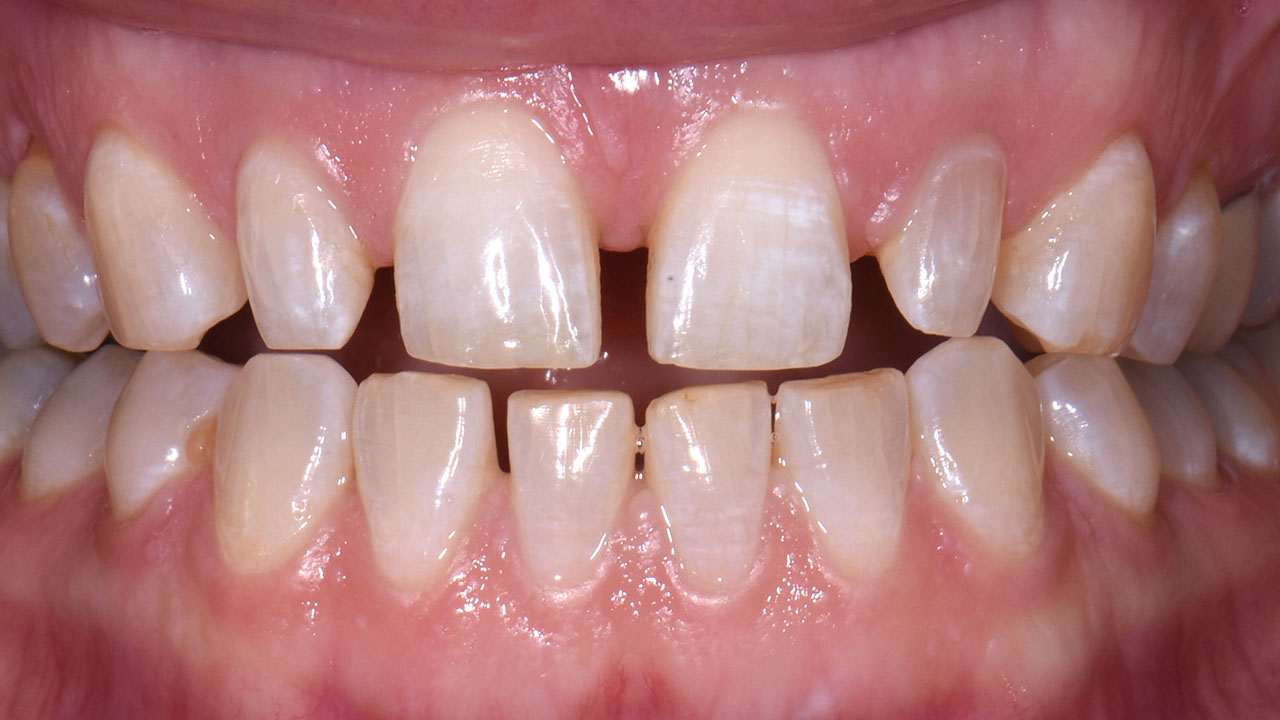 During Orthodontic Treatment Tooth Spacing Grandville Mi