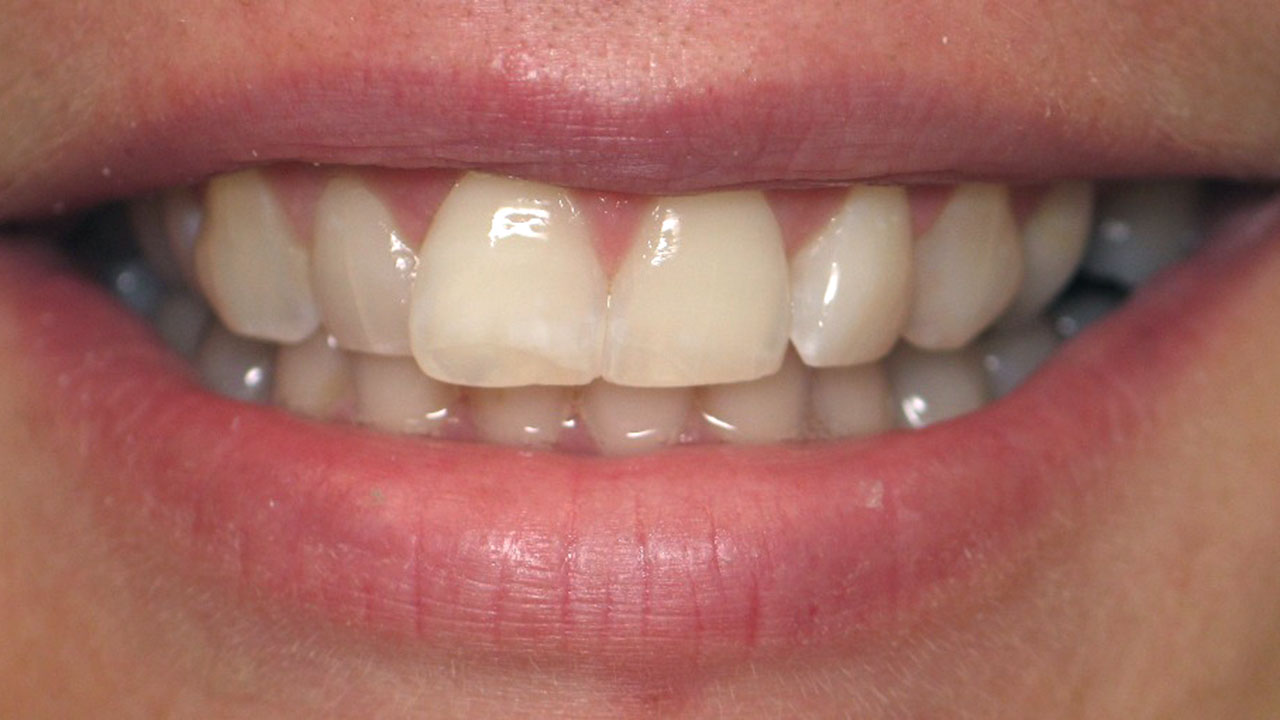 Enamel White Spot Discoloration After Microabrasion Grandville Mi