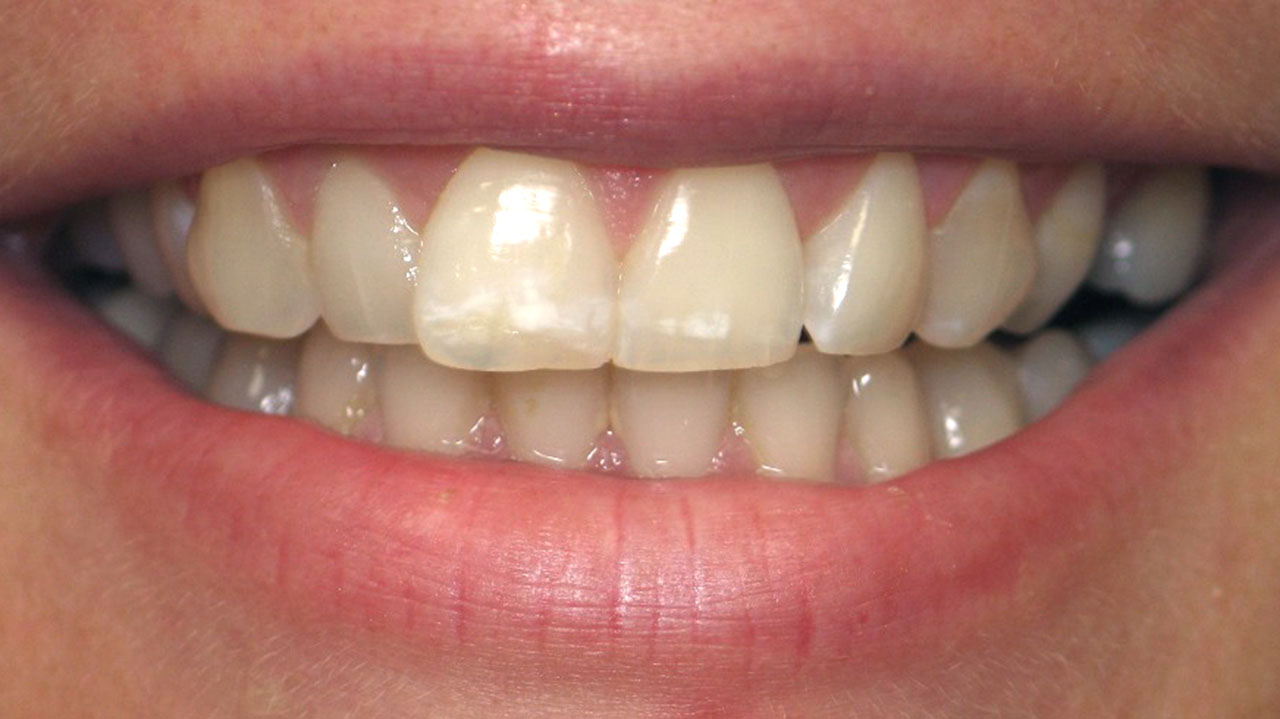 Enamel White Spot Discoloration Before Microabrasion Grandville Mi