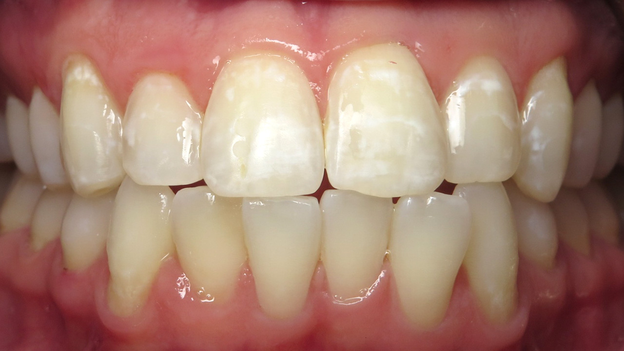 Front Teeth White Spots After Microabrasion Grandville Mi