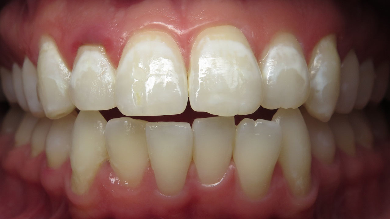 Front Teeth White Spots Before Microabrasion Grandville Mi