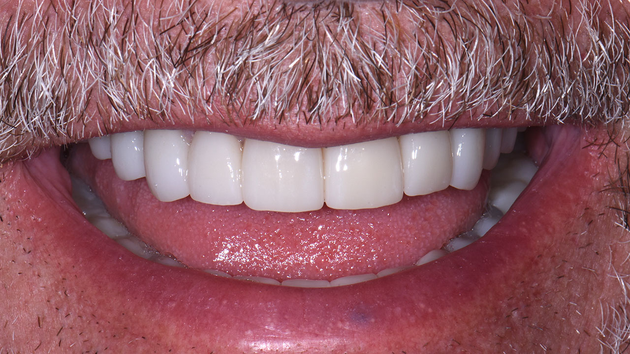 Full Mouth Rehabilitation Broken Teeth Close Smile After Grandville Mi