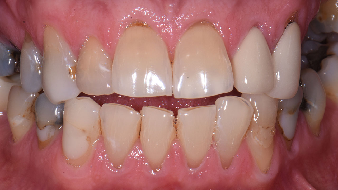 Full Mouth Rehabilitation Broken Teeth Retracted Before Grandville Mi