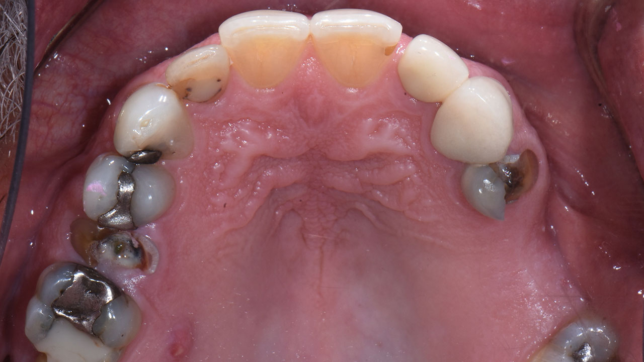 Full Mouth Rehabilitation Broken Upper Teeth Before Grandville Mi