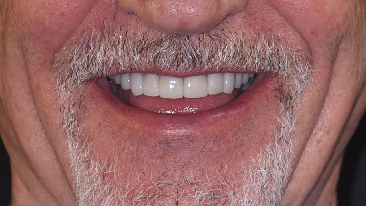 Full Mouth Rehabilitation Chewing Problems Smile After Grandville Mi