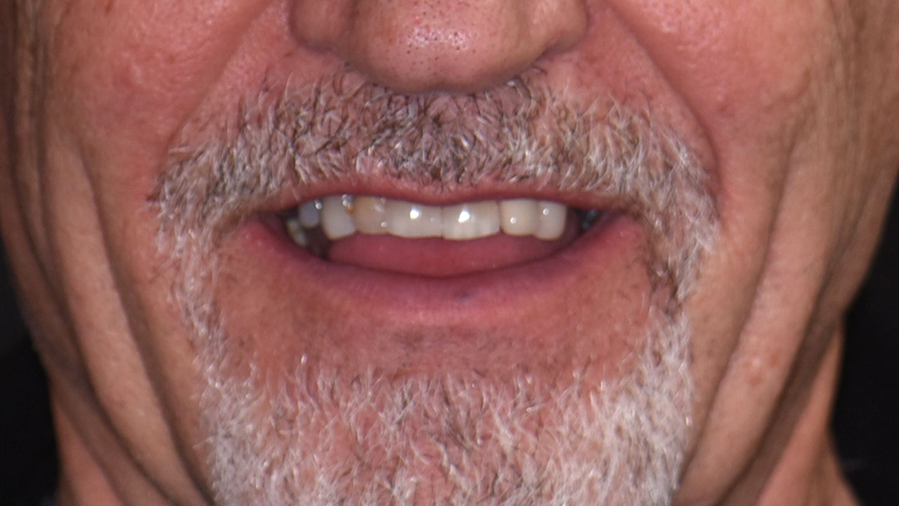 Full Mouth Rehabilitation Chewing Problems Smile Before Grandville Mi