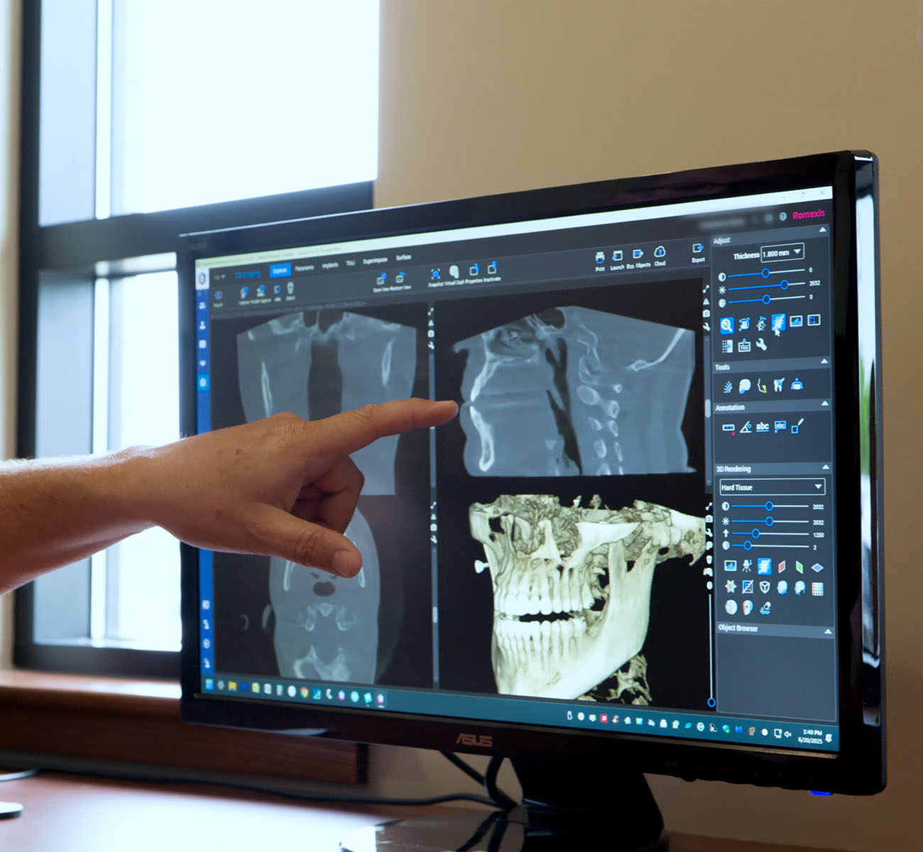 Full Mouth Rehabilitation Dentist Grandville Mi Full Mouth Rehabilitation Dentist Grandville Mi