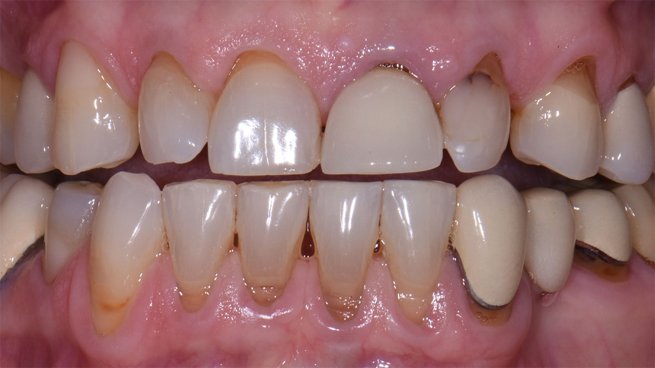 Full Mouth Rehabilitation Failing Dentistry Before Grandville Mi