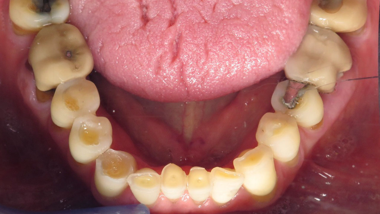 Full Mouth Rehabilitation Hopeless Lower Teeth Before Grandville Mi