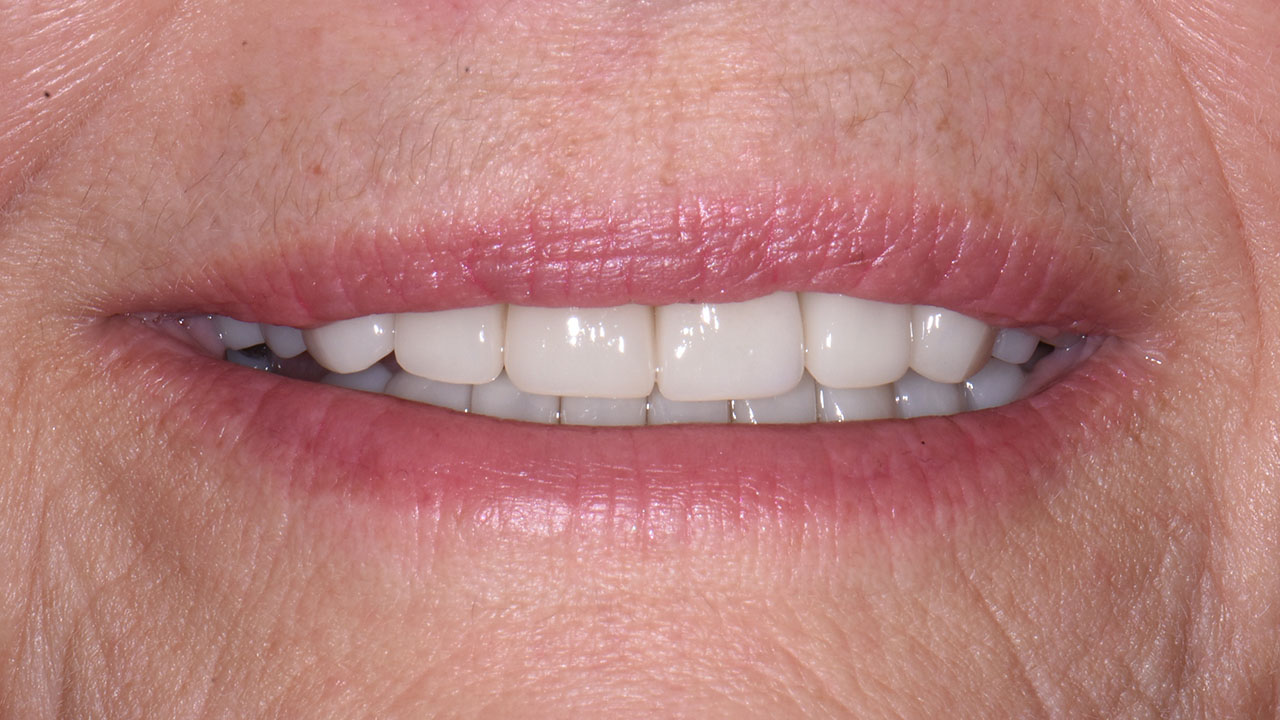 Full Mouth Rehabilitation Implant Ortho Smile After Grandville Mi