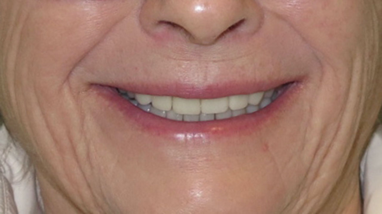 Full Mouth Rehabilitation Implant Ortho Smile After Grandville Michigan