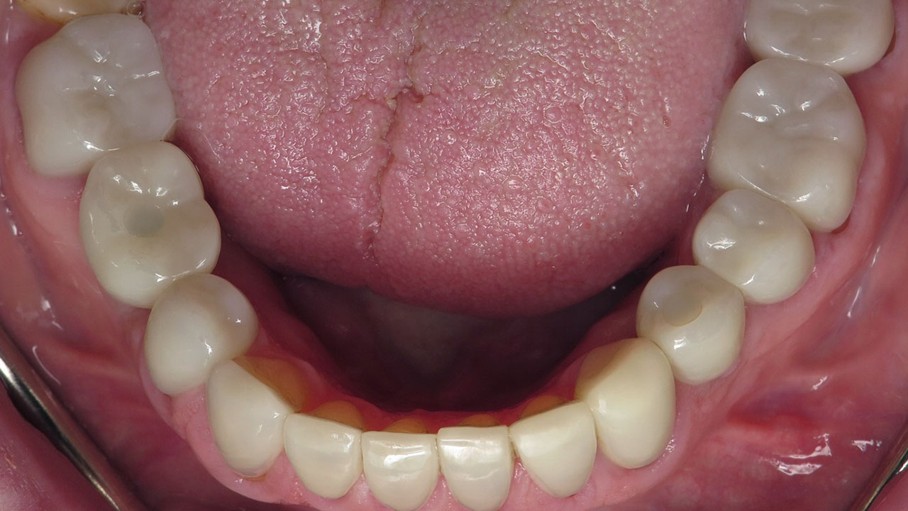 Full Mouth Rehabilitation Lower Teeth After Treatment Grandville Mi