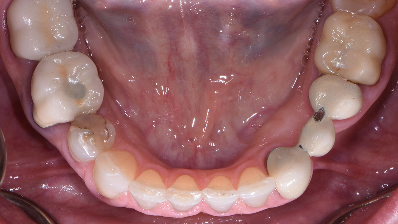 Full Mouth Rehabilitation Lower Teeth Before Treatment Grandville Mi
