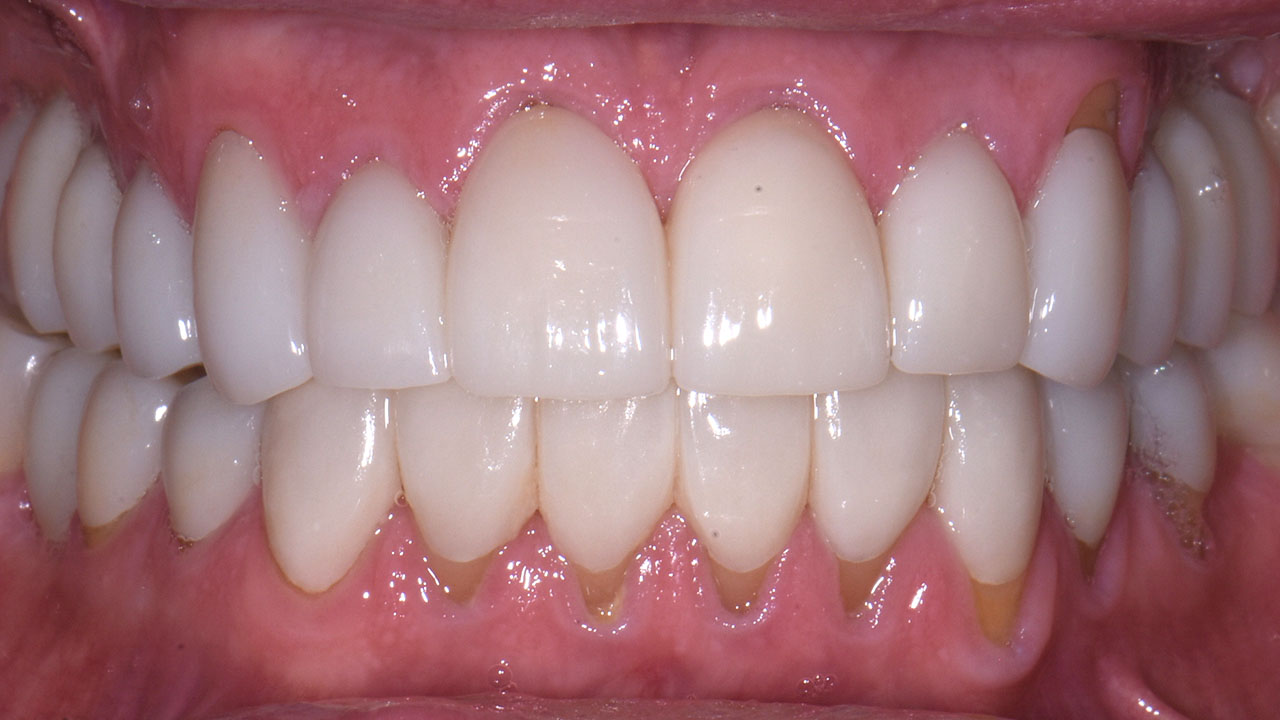 Full Mouth Rehabilitation Restored Bite Retracted After Grandville Mi