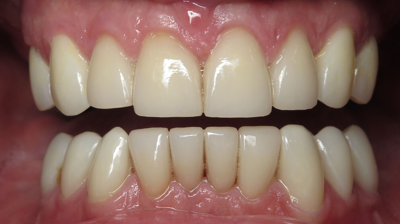 Full Mouth Rehabilitation Restored Bite Retracted After Grandville Mi