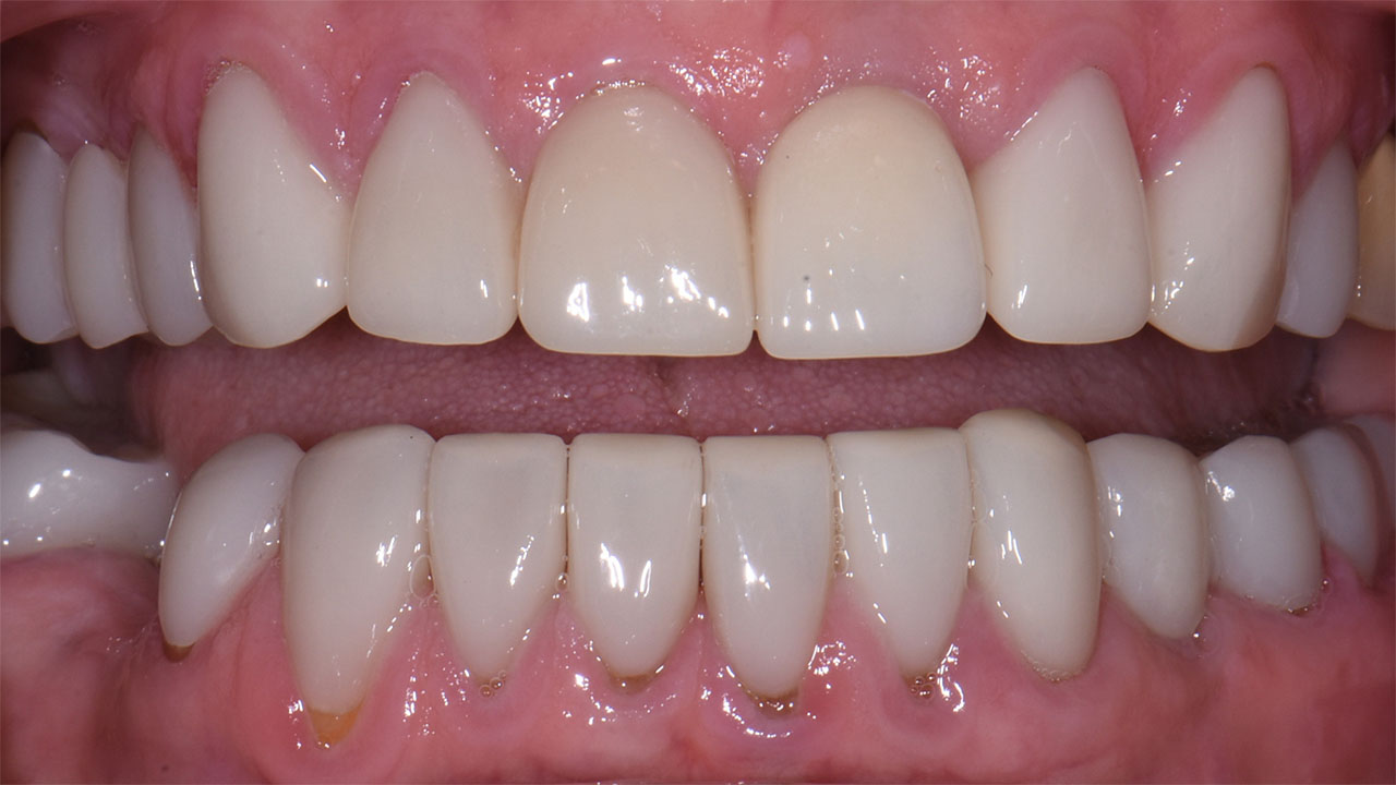 Full Mouth Rehabilitation Restored Dentition After Grandville Mi