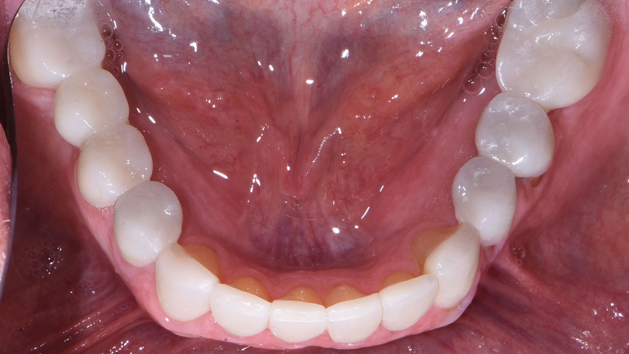 Full Mouth Rehabilitation Restored Lower Teeth After Grandville Mi