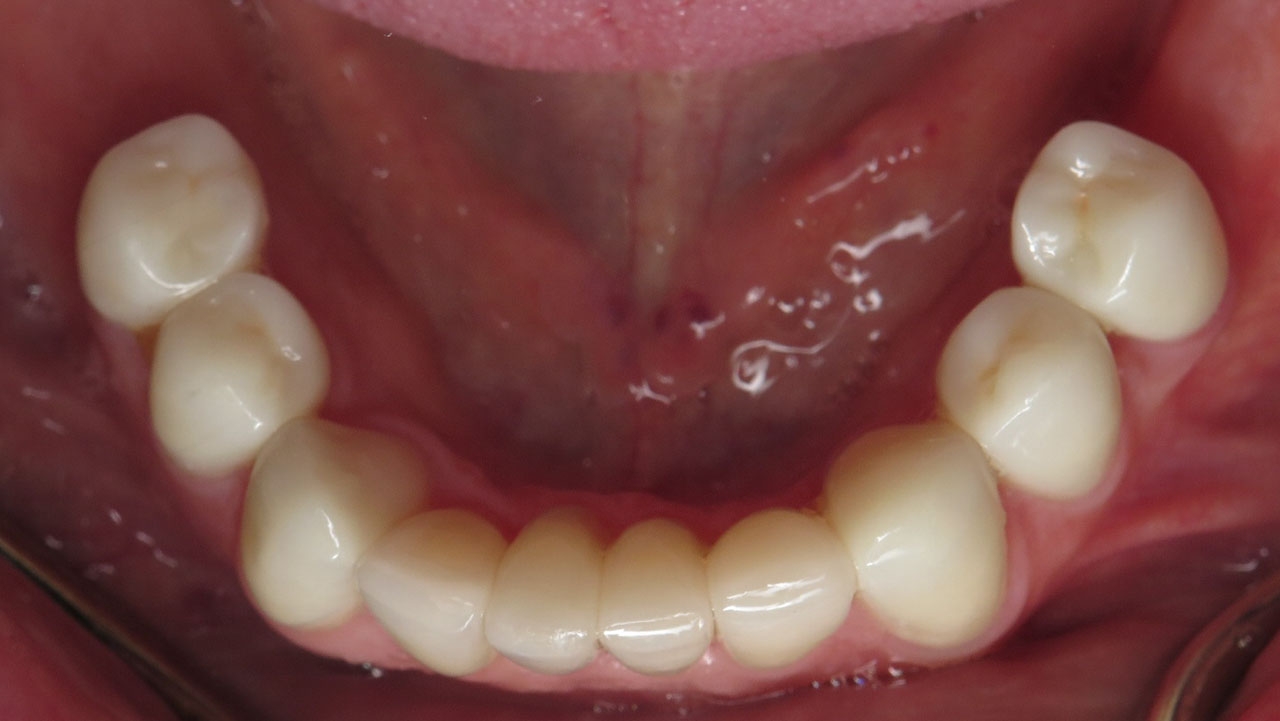 Full Mouth Rehabilitation Restored Lower Teeth After Grandville Mi