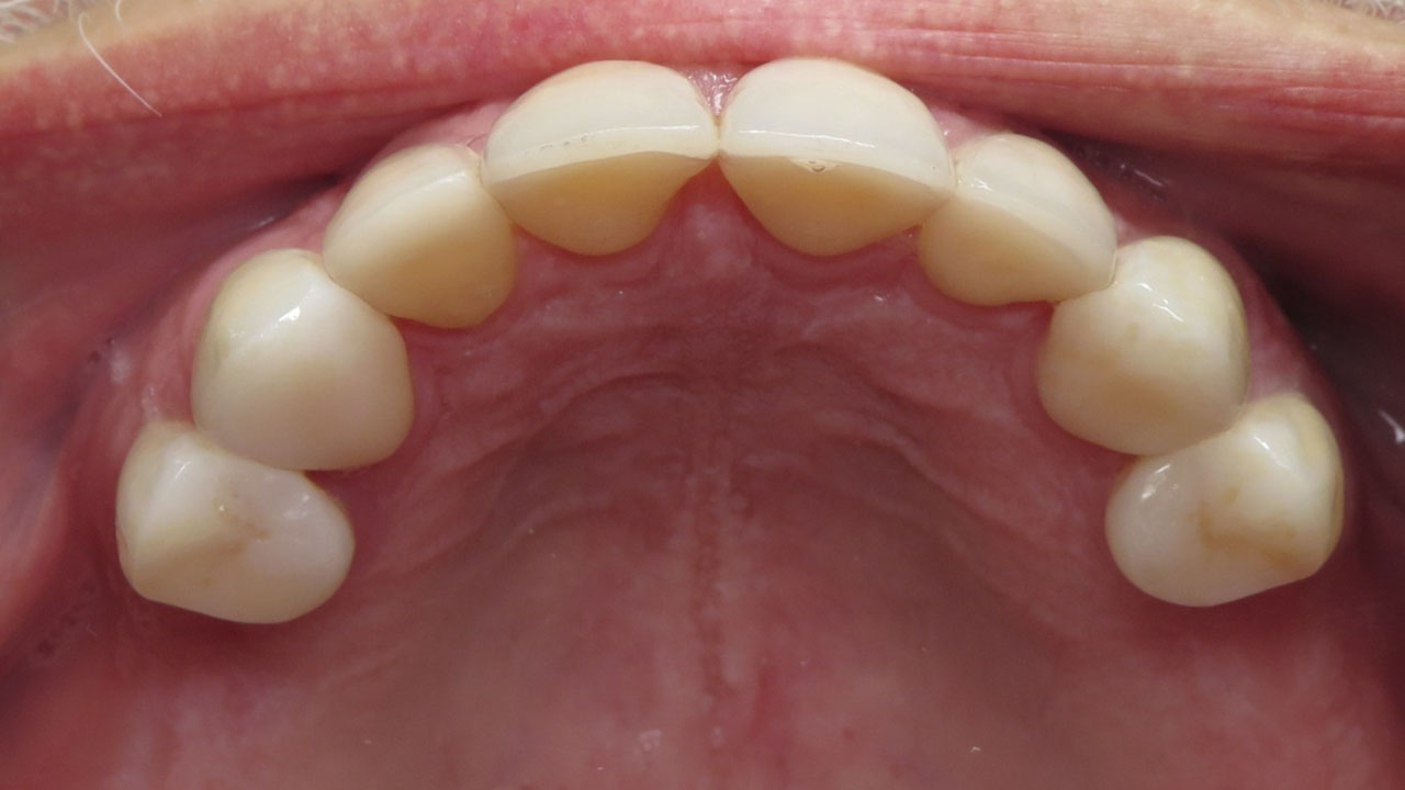 Full Mouth Rehabilitation Restored Upper Teeth After Grandville Mi