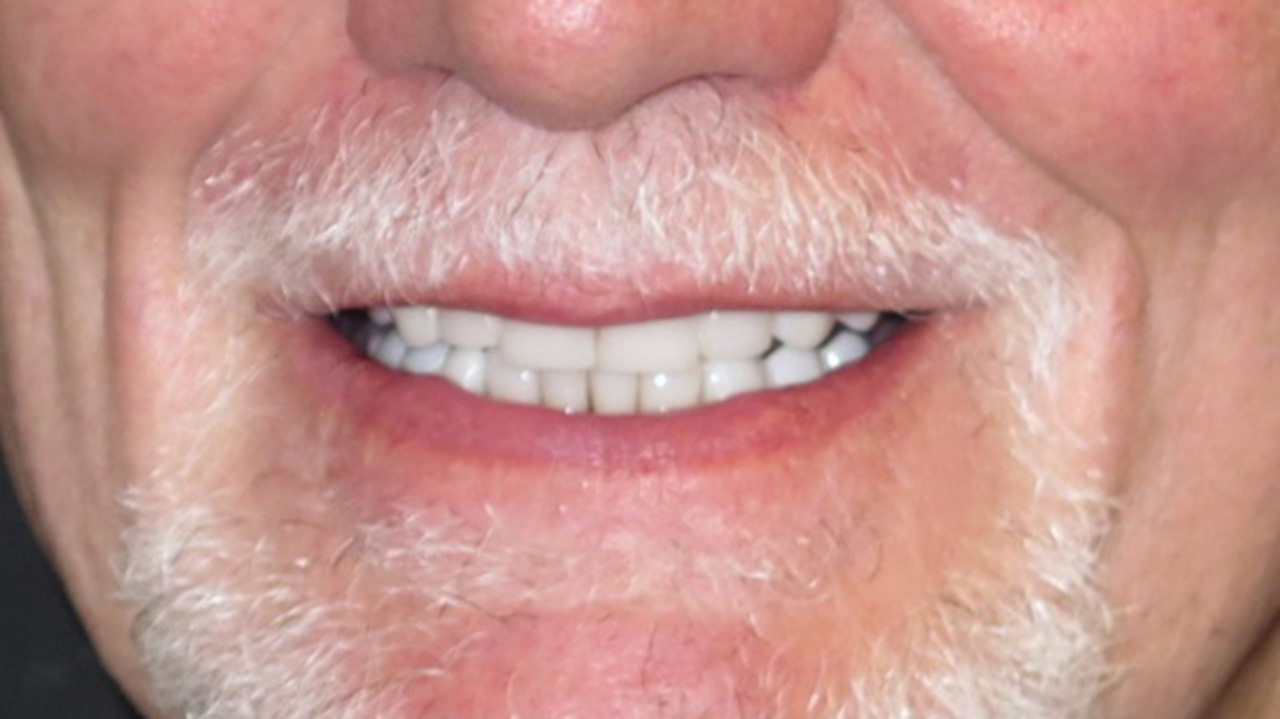 Full Mouth Rehabilitation Severe Tooth Grinding Smile After Grandville Mi