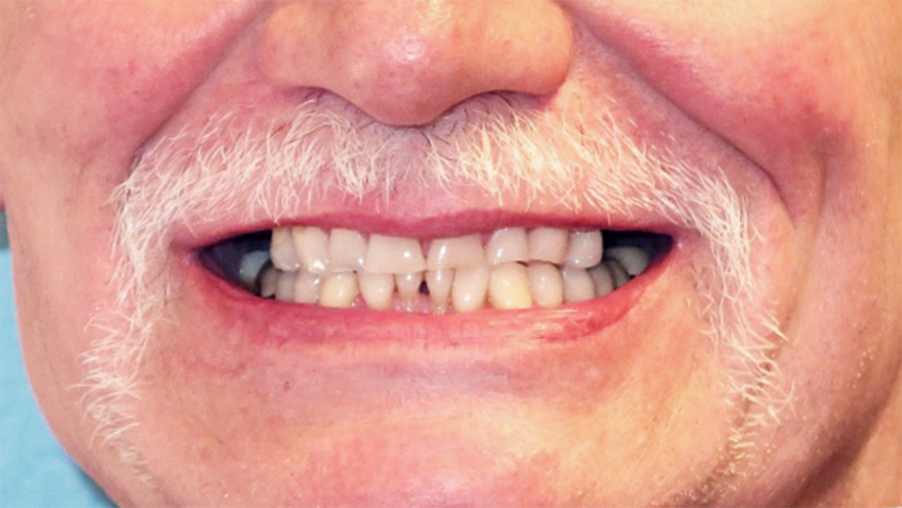 Full Mouth Rehabilitation Severe Tooth Grinding Smile Before Grandville Mi