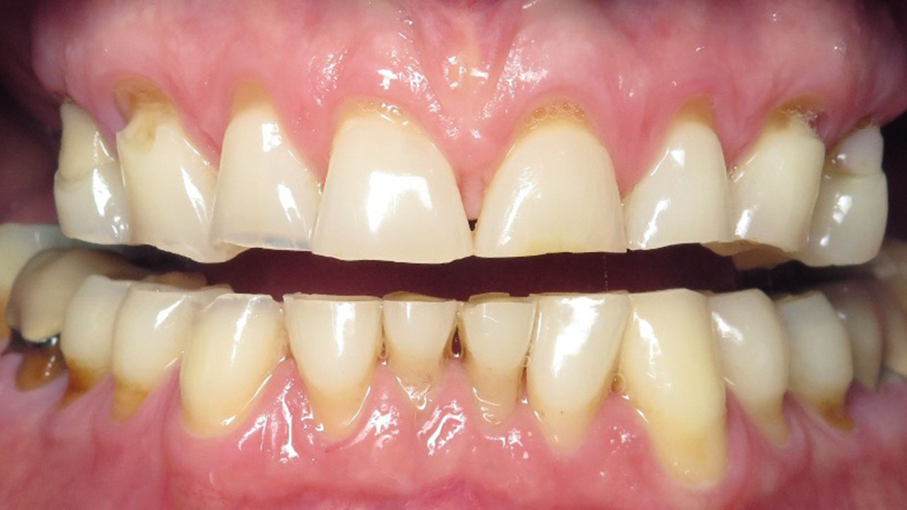 Full Mouth Rehabilitation Severely Worn Teeth Retracted Before Grandville Mi