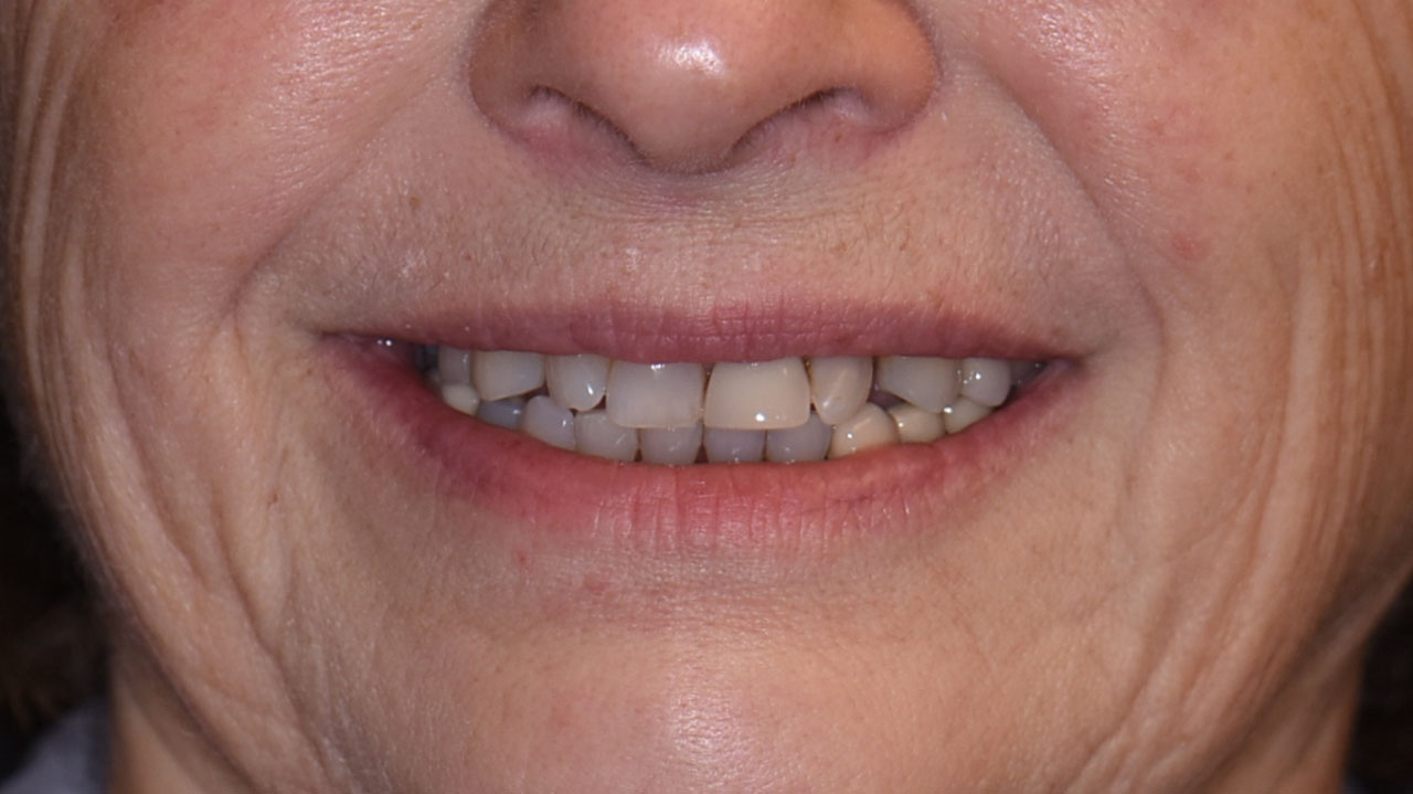 Full Mouth Rehabilitation Spaced Smile Loose Front Tooth Before Grandville Mi