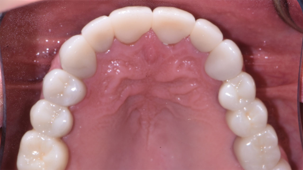 Full Mouth Rehabilitation Upper Implants Bridge After Grandville Mi