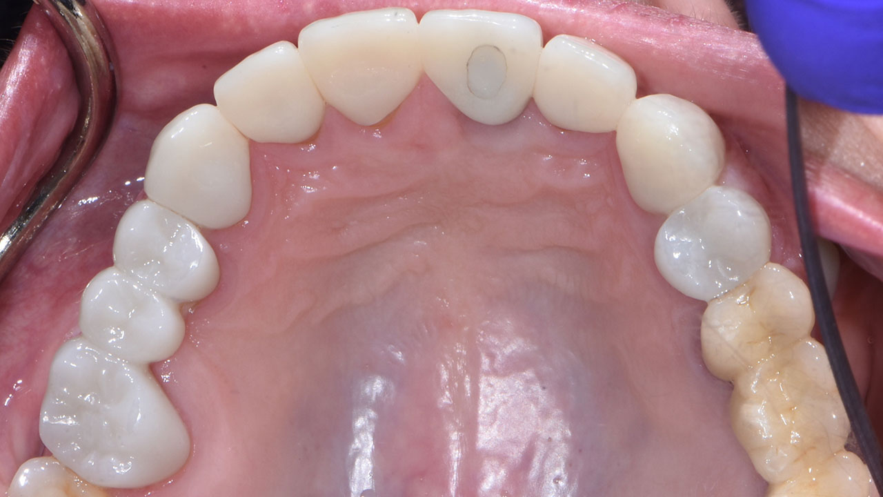 Full Mouth Rehabilitation Upper Teeth After Treatment Grandville Mi