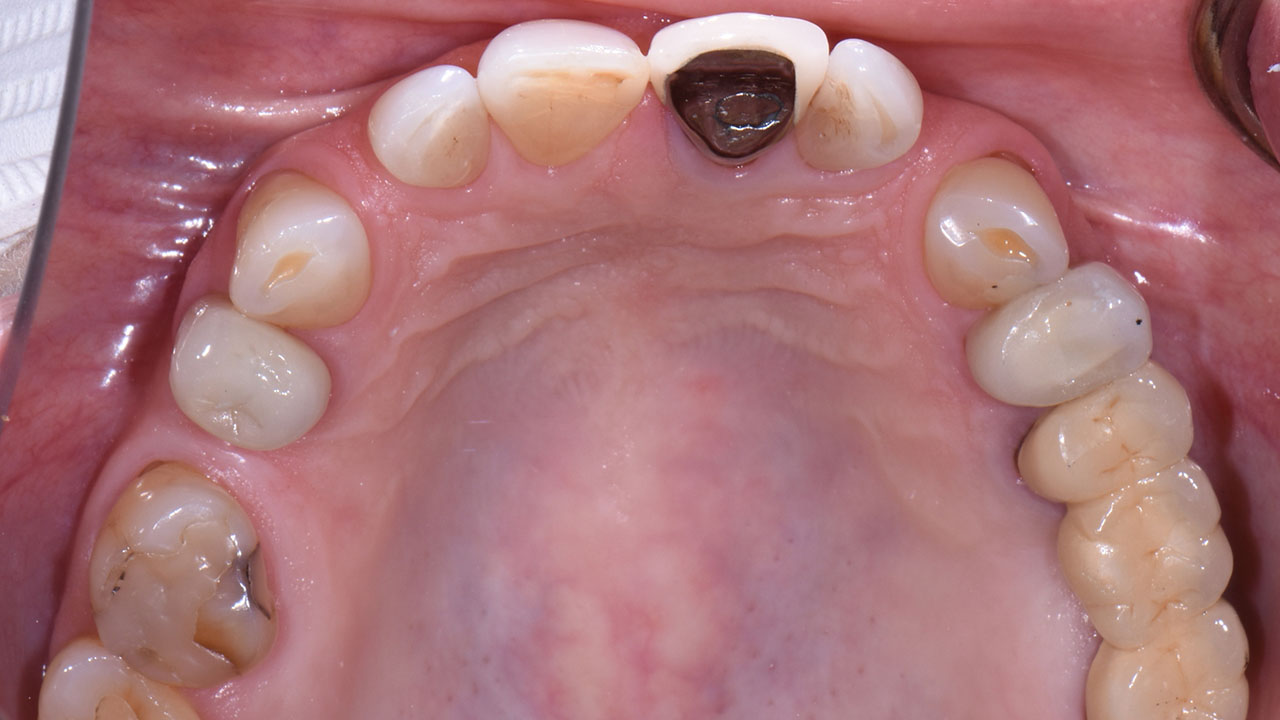 Full Mouth Rehabilitation Upper Teeth Before Treatment Grandville Mi