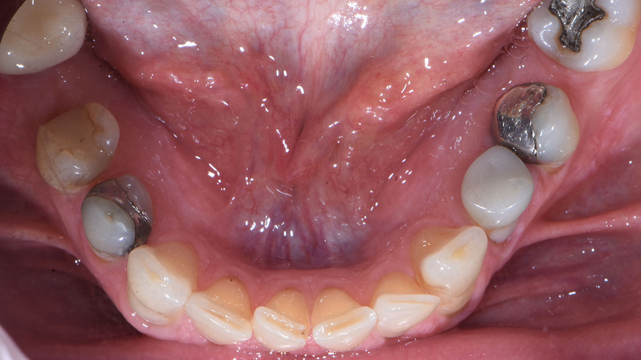 Full Mouth Rehabilitation Worn Lower Teeth Before Grandville Mi