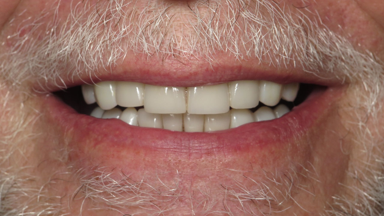 Full Mouth Rehabilitation Worn Teeth Close Smile After Grandville Mi