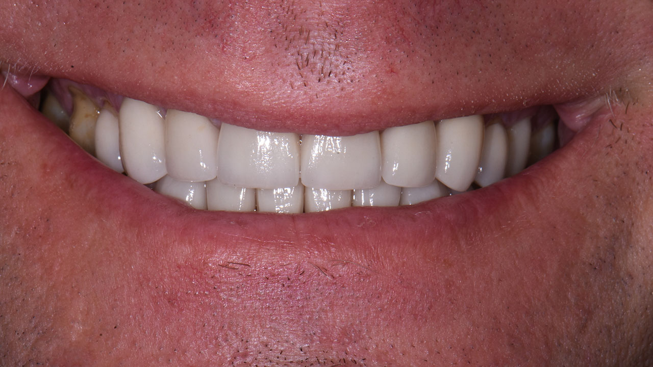 Full Mouth Rehabilitation Worn Teeth Close Smile After Grandville Mi
