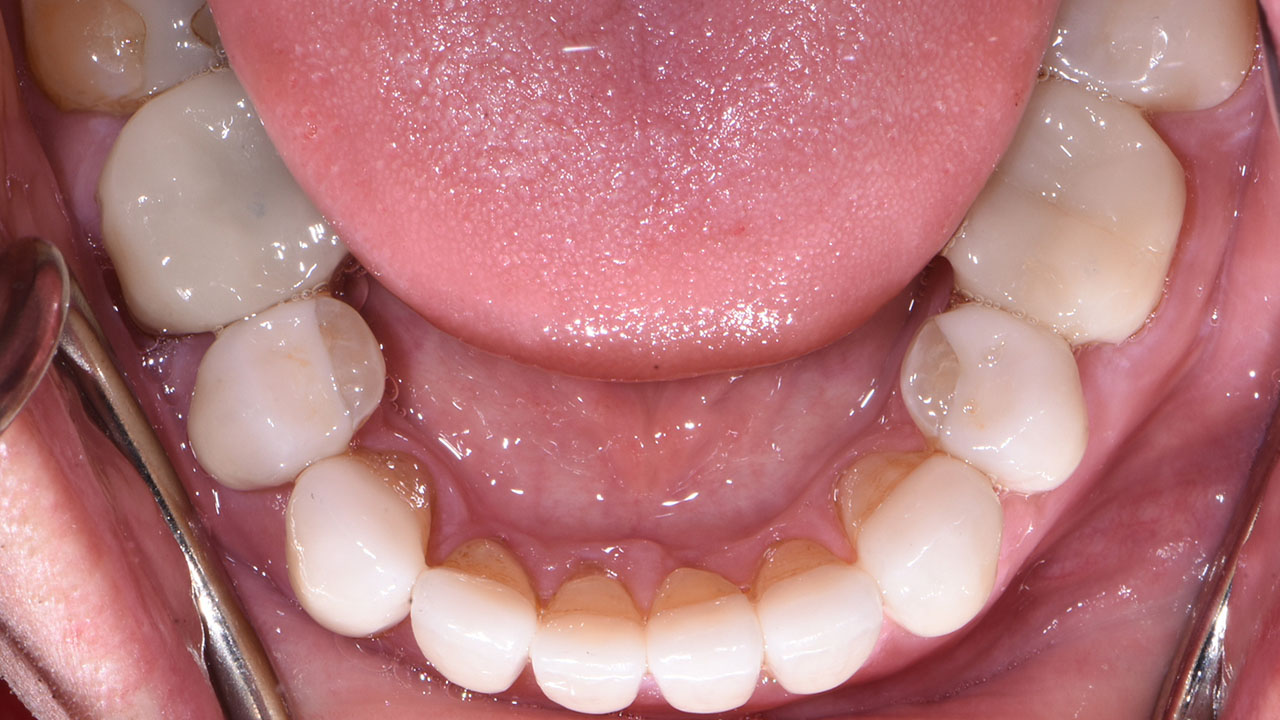 Full Mouth Rehabilitation Worn Teeth Lower Occlusal After Grandville Mi