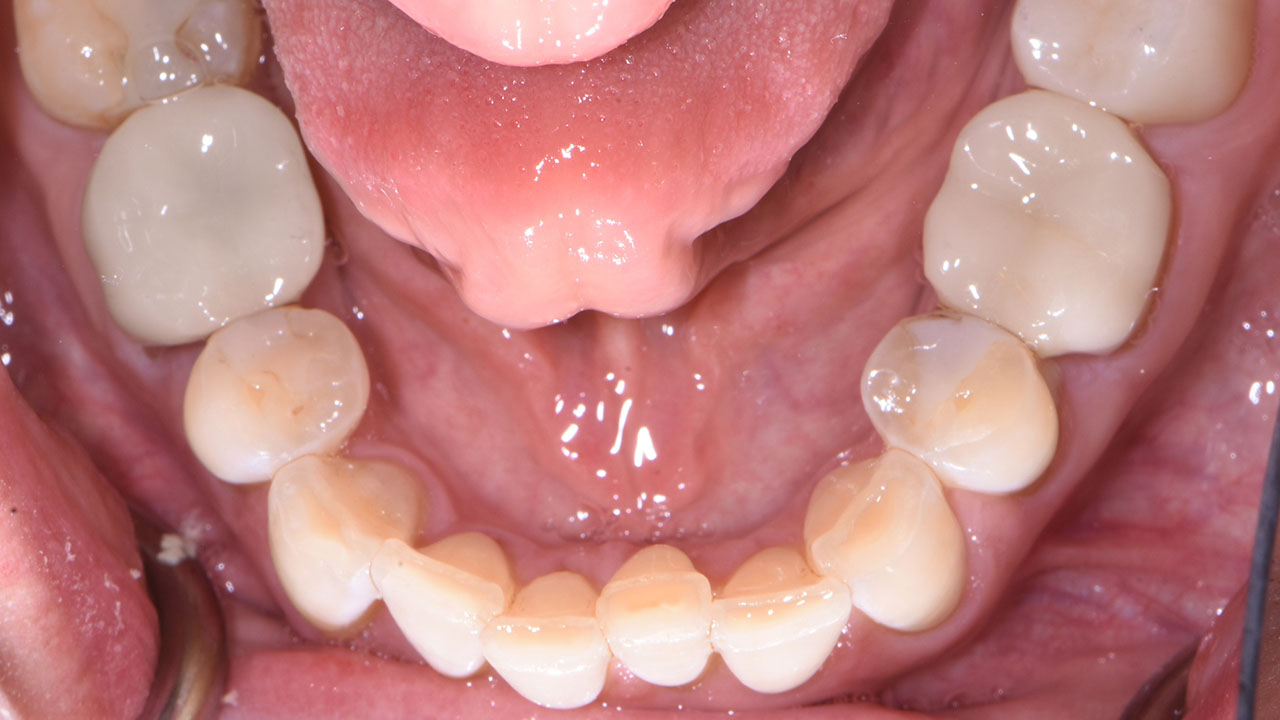 Full Mouth Rehabilitation Worn Teeth Lower Occlusal Before Grandville Mi