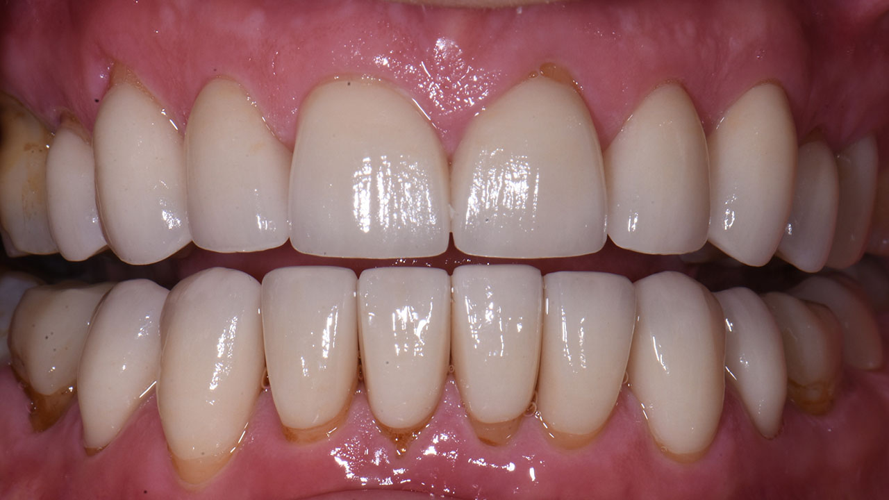 Full Mouth Rehabilitation Worn Teeth Retracted After Grandville Mi