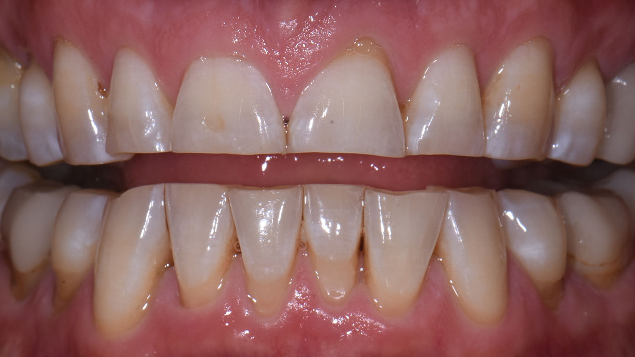 Full Mouth Rehabilitation Worn Teeth Retracted Before Grandville Mi