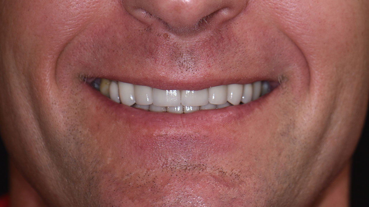 Full Mouth Rehabilitation Worn Teeth Smile After Grandville Mi