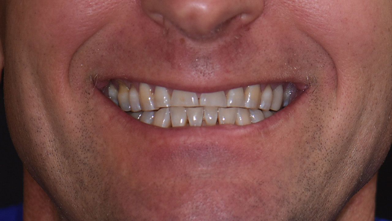 Full Mouth Rehabilitation Worn Teeth Smile Before Grandville Mi