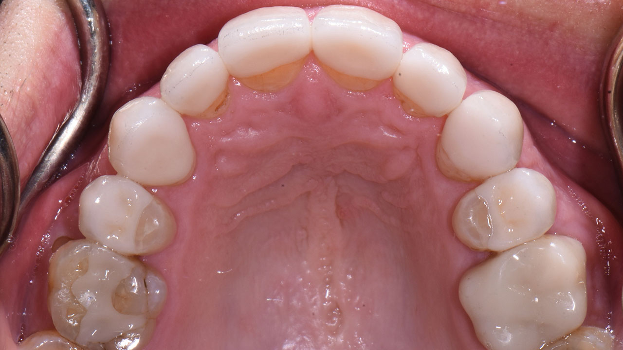 Full Mouth Rehabilitation Worn Teeth Upper Occlusal After Grandville Mi