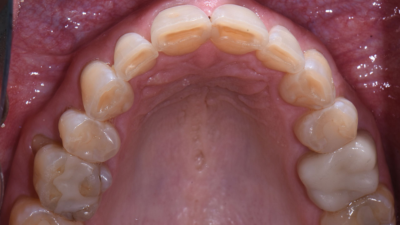 Full Mouth Rehabilitation Worn Teeth Upper Occlusal Before Grandville Mi