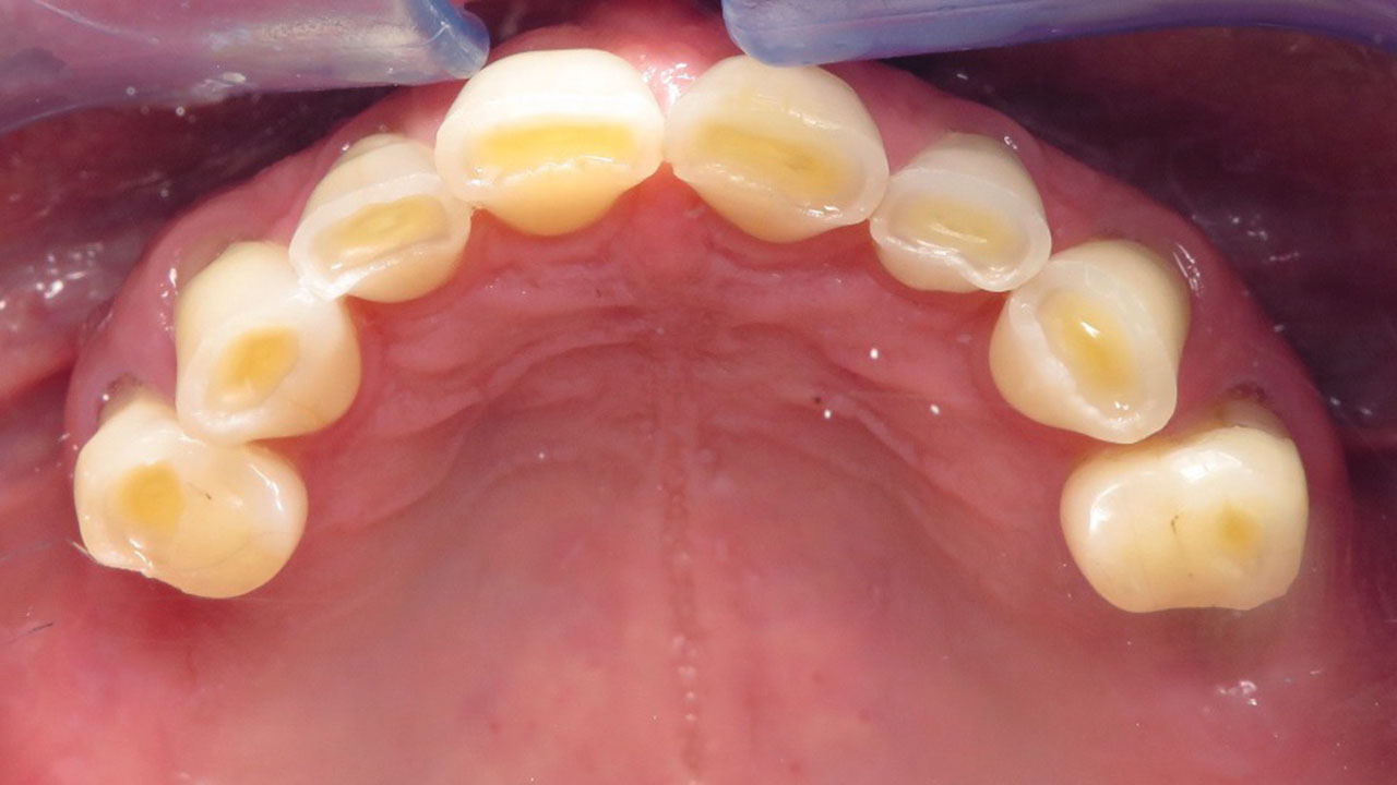 Full Mouth Rehabilitation Worn Upper Teeth Before Grandville Mi