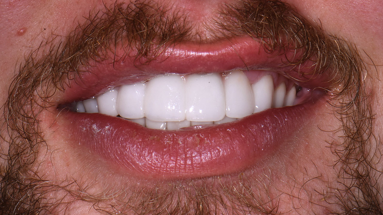 Full Smile Restoration Veneers Bridge Close Up After Grandville Mi