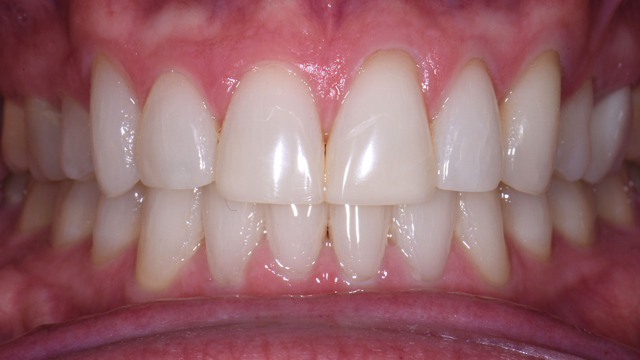 Grandville Mi Bonding Case After Retracted