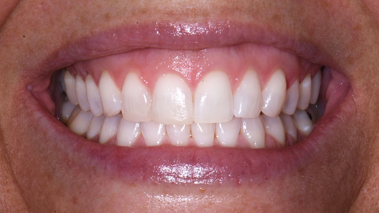 Grandville Mi Bonding Worn Front Teeth After Close